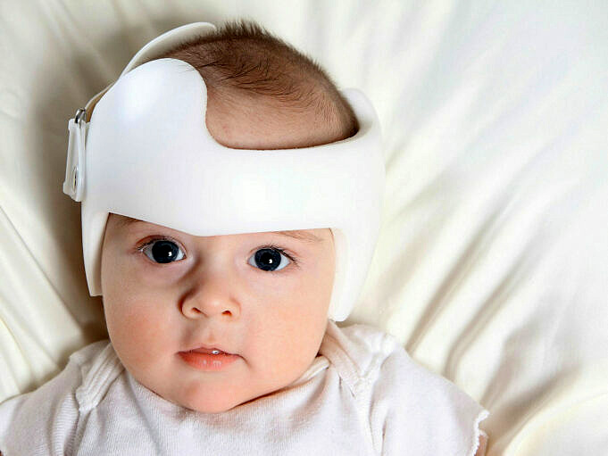Wie Man Das Flat-Head-Syndrom Bei Babys Verhindert Und Heilt